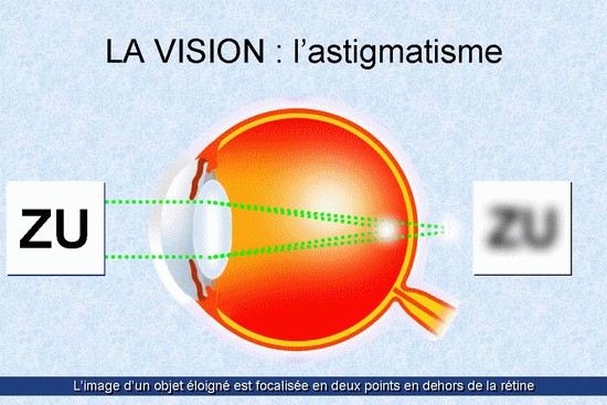 L'astigmatisme