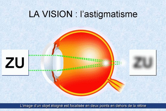 L'astigmatisme