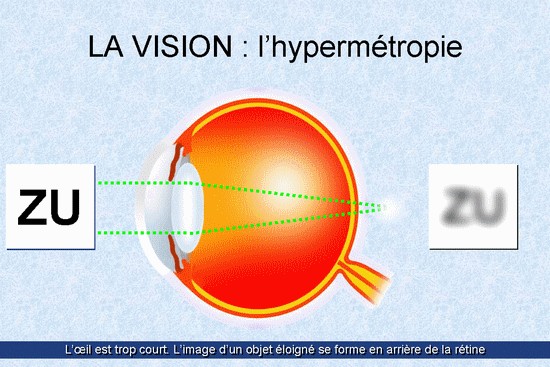 L'hypermétropie
