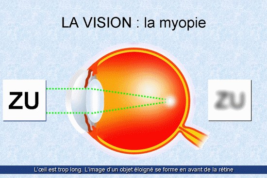 La myopie