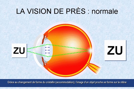 La presbytie La presbytie