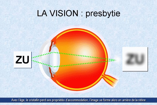 La presbytie